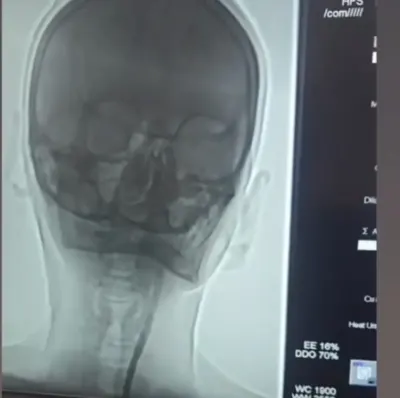 Iğdır Devlet Hastanesinde Şah Damarı Tıkanıklığına Başarılı Stent Operasyonu